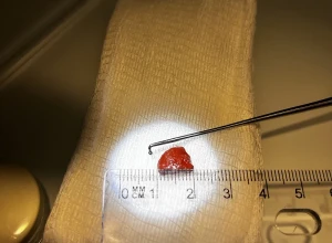 В Ромашково врачи помогли 3-летней девочке, которая засунула в нос камень из аквариума