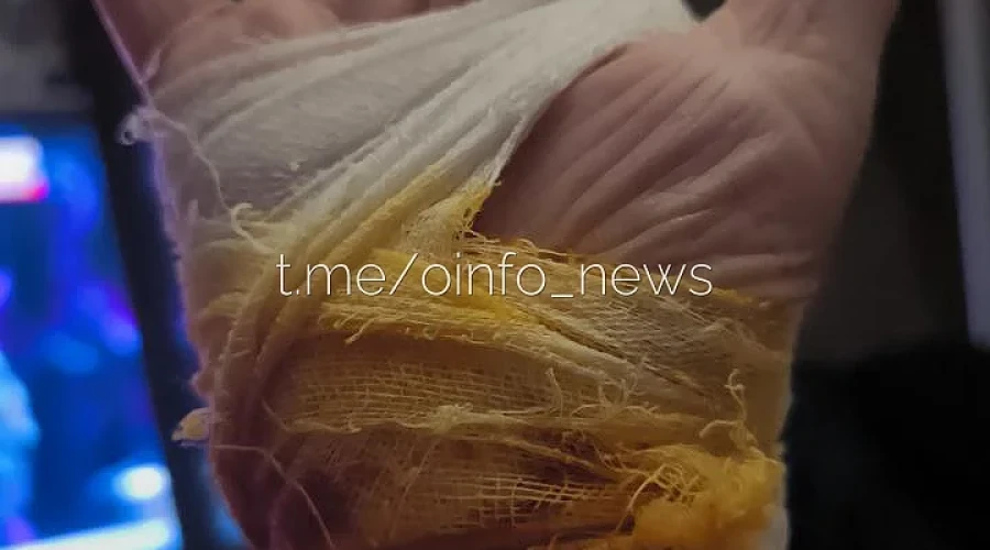 «Перекушена часть кисти»: в Трёхгорке хозяйка собачки пострадала от крупного пса, защищая питомца