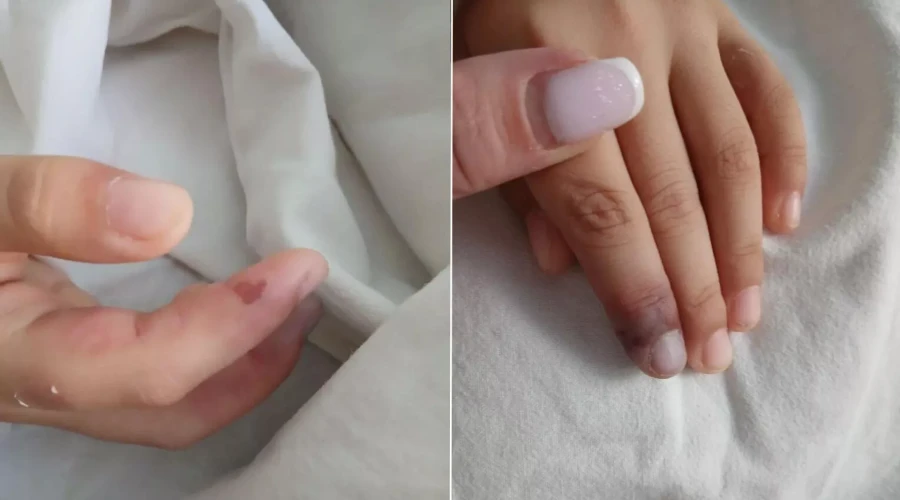 Саратовские врачи спасли девочку с редким аутоиммунным заболеванием